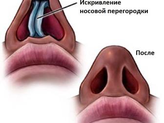 Правка носа, коррекция носа, без операции