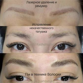 Лазерное удаление татуажа и татуировок