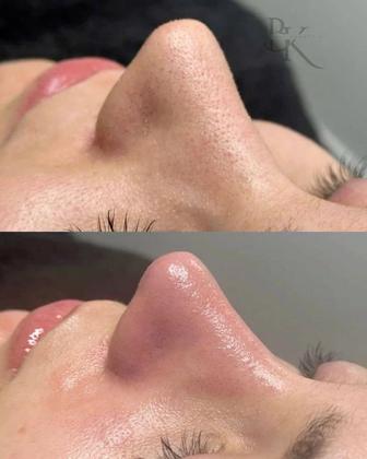 Чистки лица