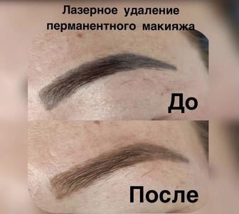 Удаление татуажа татуировок