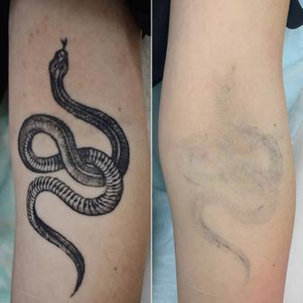 Удаление татуировок