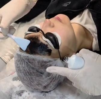 Карбоновый пилинг 4/1