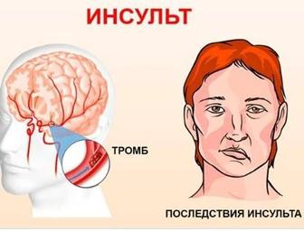 Восстанавление после инсульта