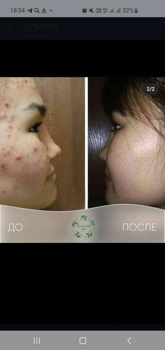 Чистка лица