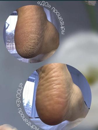 Подолог( педикюр при проблемных ногтях и стопках)