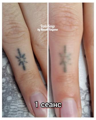 Удаление тату и татуажа