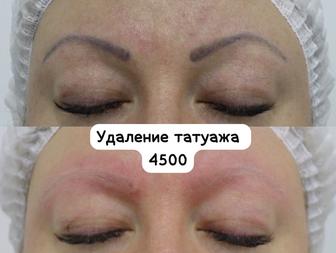 Удаление Татуажа