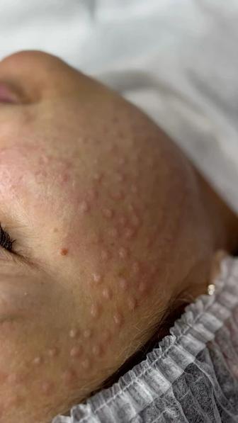 Плазмолифтинг