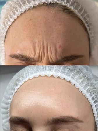 Ботокс ! Убираю морщины !