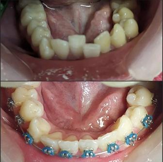 Стоматология / Брекеты / Удаление