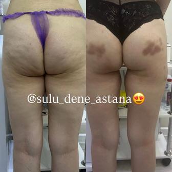 Аппаратный массаж для похудение