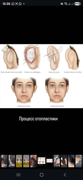 Обучение по отопластике ушей