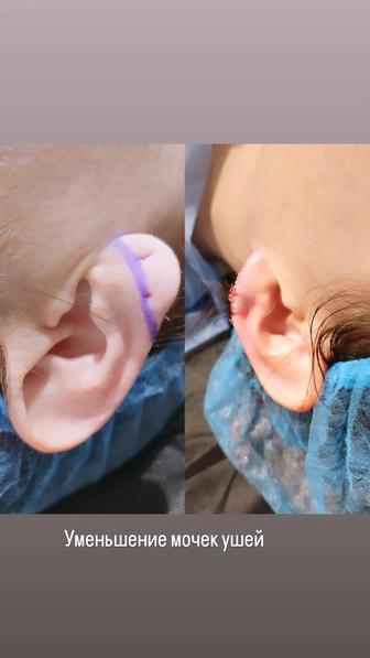 Ушивание мочек ушей в клинике