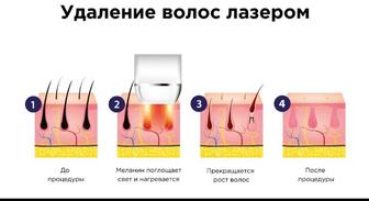 Лазерная эпиляция