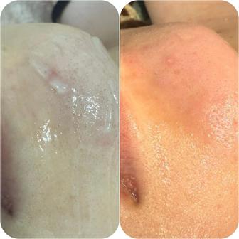 Ищу модель на чистку лица