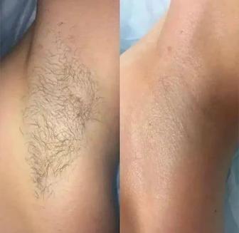 Шугаринг пастой и воском