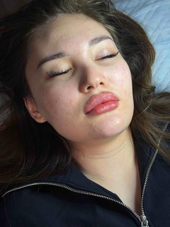 Увеличение губ в Алматы Натуральный результат