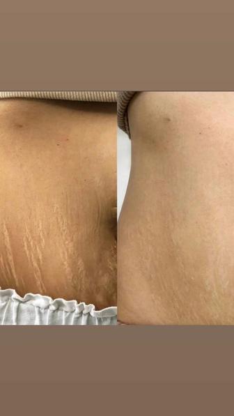 Лазерная шлифовка кожи