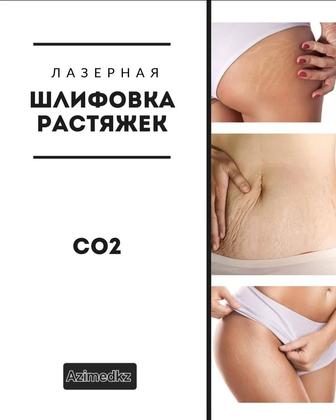 Лазерная шлифовка кожи